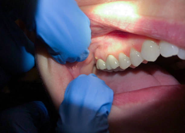 Best Knocked-Out Tooth Emergency  in Thunder Mountain, NM